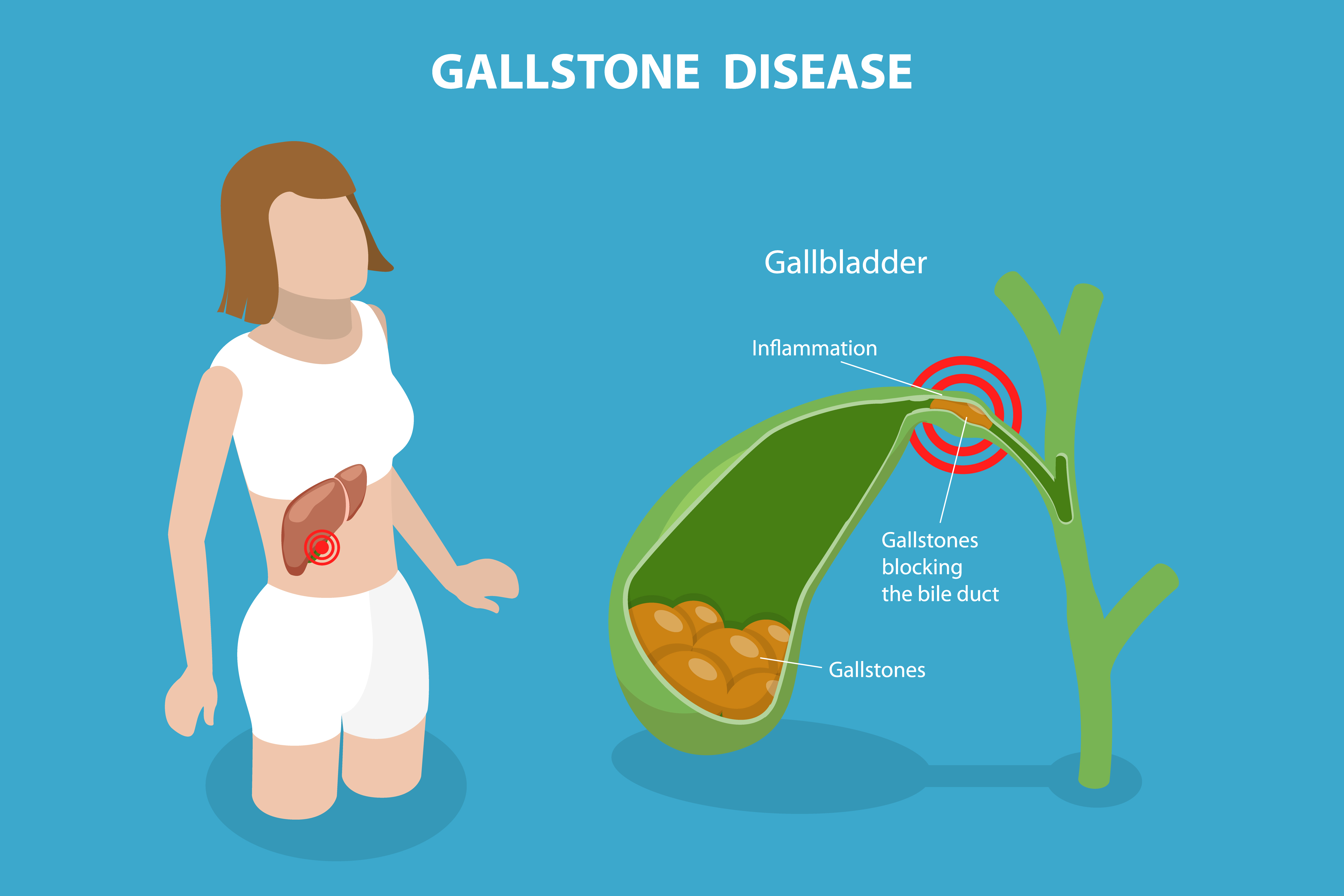 Identify Gallstone & Pancreatitis Triggers